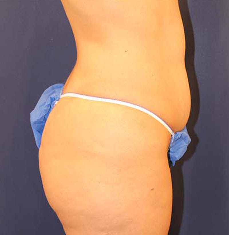 Liposuction Before & After Gallery - Patient 174162048 - Image 5