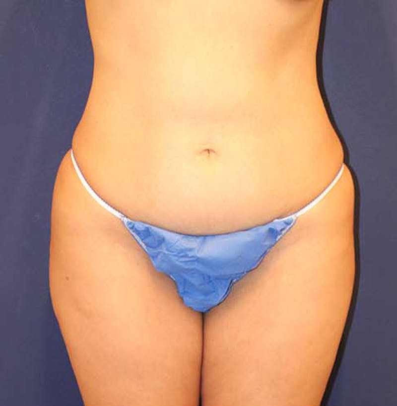 Liposuction Before & After Gallery - Patient 174162048 - Image 1