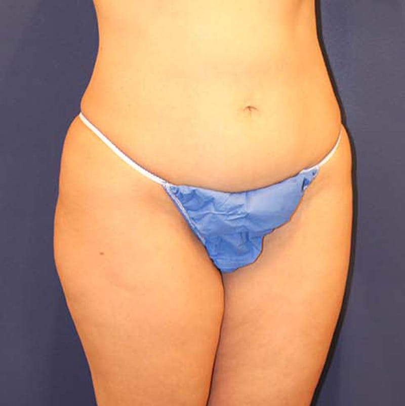 Liposuction Before & After Gallery - Patient 174162048 - Image 3