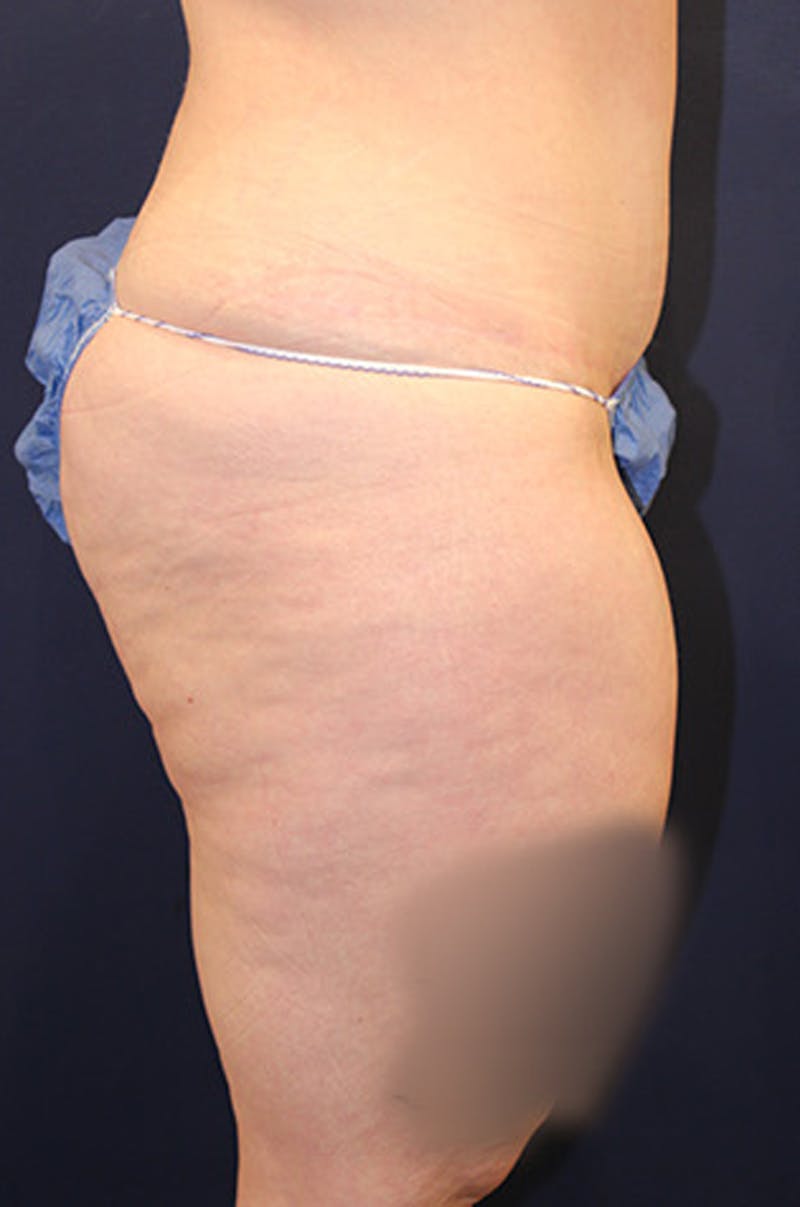 Liposuction Before & After Gallery - Patient 174162054 - Image 6