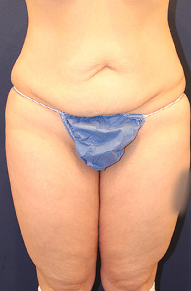 Liposuction Before & After Gallery - Patient 174162054 - Image 1