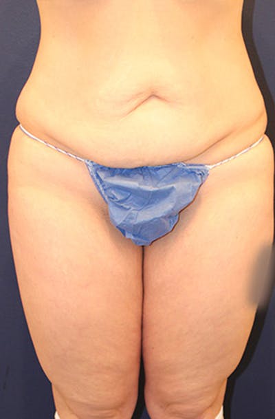 Liposuction Before & After Gallery - Patient 174162054 - Image 1