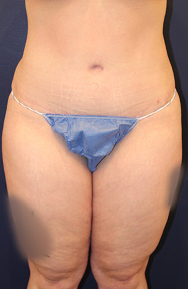 Liposuction Before & After Gallery - Patient 174162054 - Image 2
