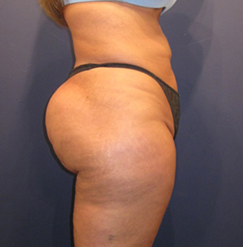 Liposuction Before & After Gallery - Patient 174162070 - Image 8