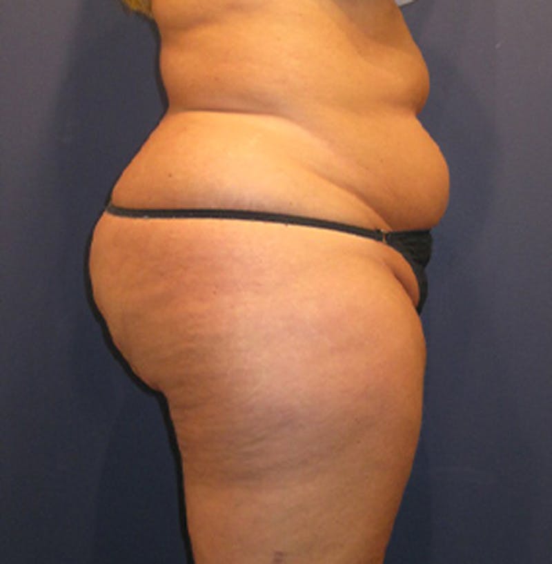 Liposuction Before & After Gallery - Patient 174162070 - Image 7