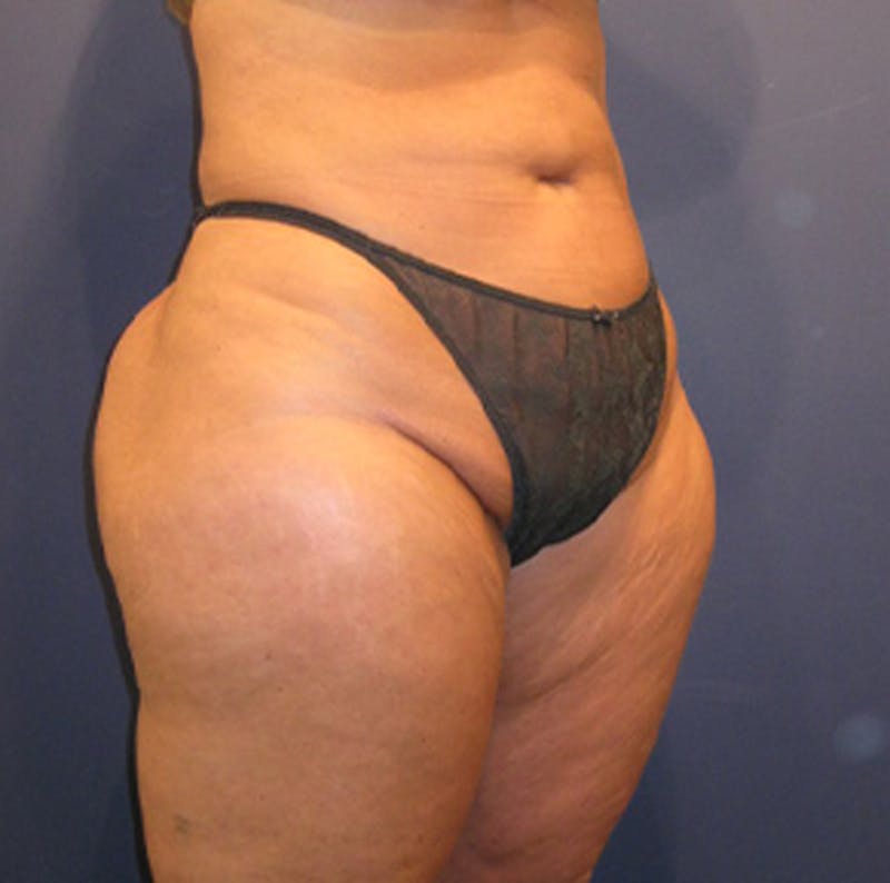 Liposuction Before & After Gallery - Patient 174162070 - Image 6