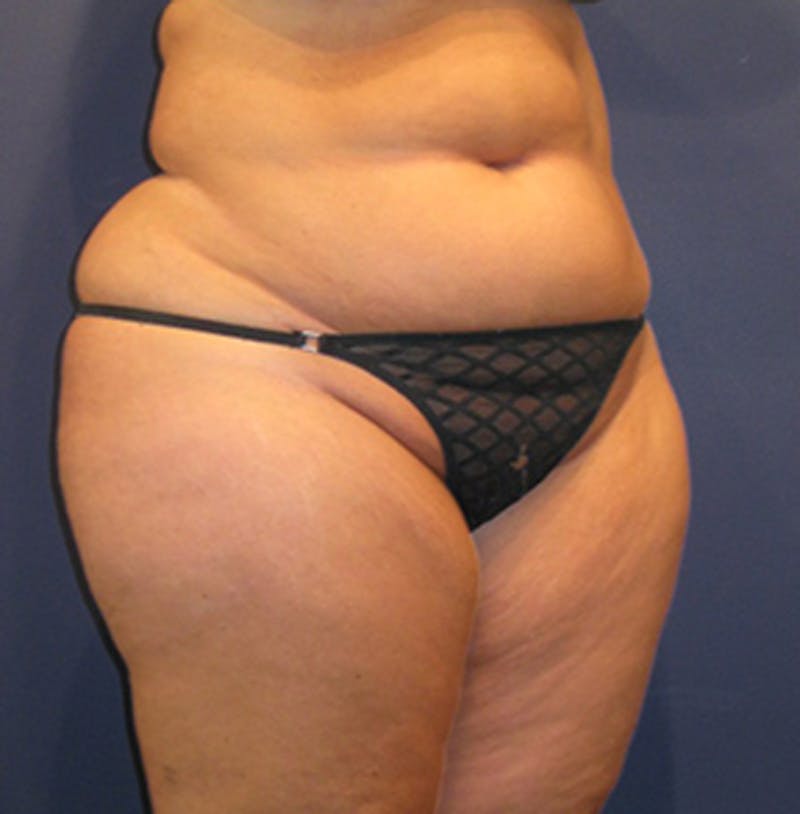 Liposuction Before & After Gallery - Patient 174162070 - Image 4