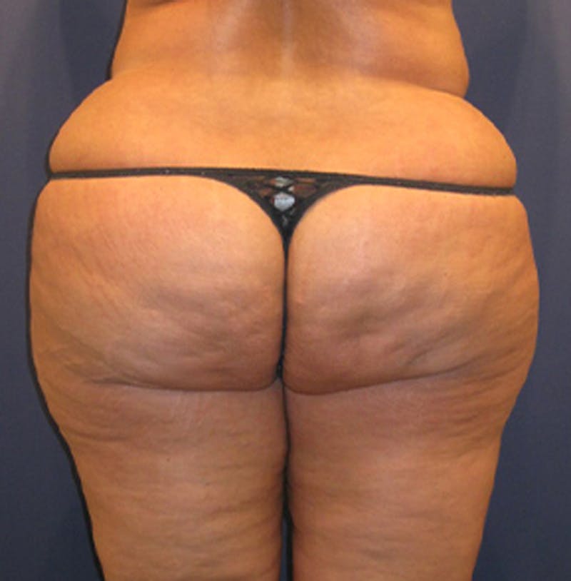 Liposuction Before & After Gallery - Patient 174162070 - Image 1