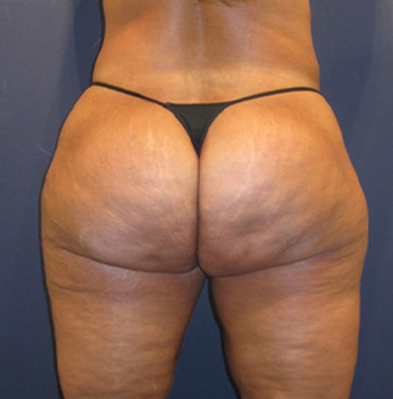 Liposuction Before & After Gallery - Patient 174162070 - Image 2