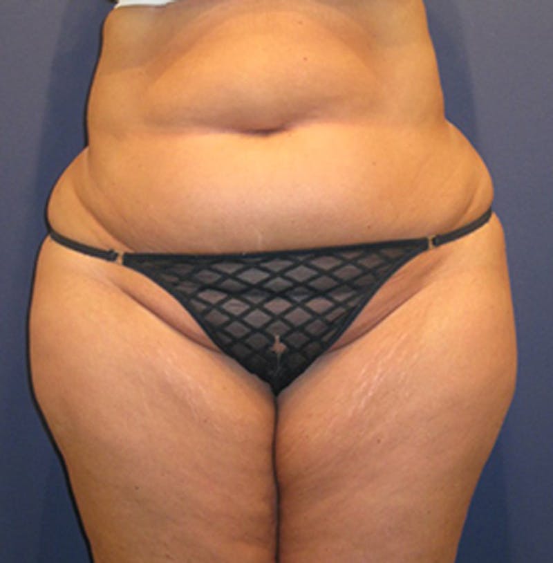 Liposuction Before & After Gallery - Patient 174162070 - Image 3