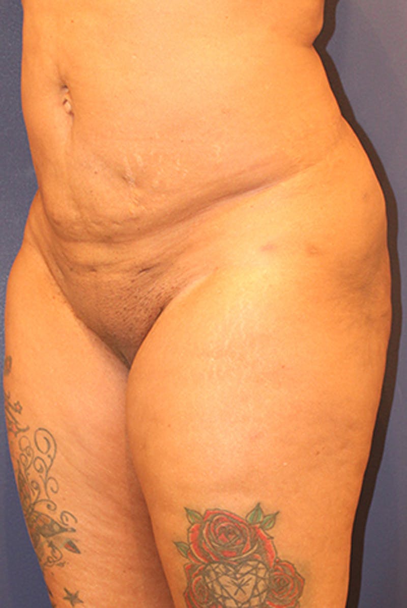 Liposuction Before & After Gallery - Patient 174162081 - Image 4