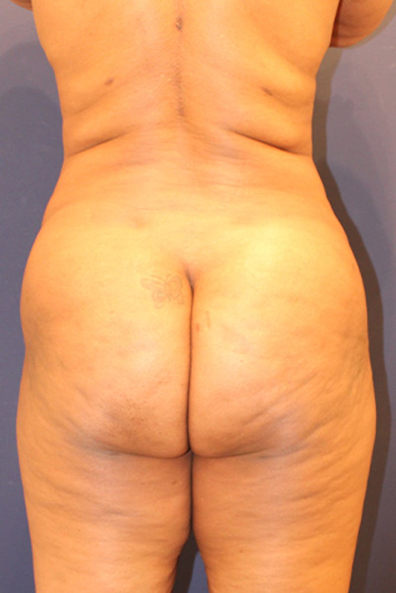 Liposuction Before & After Gallery - Patient 174162081 - Image 2
