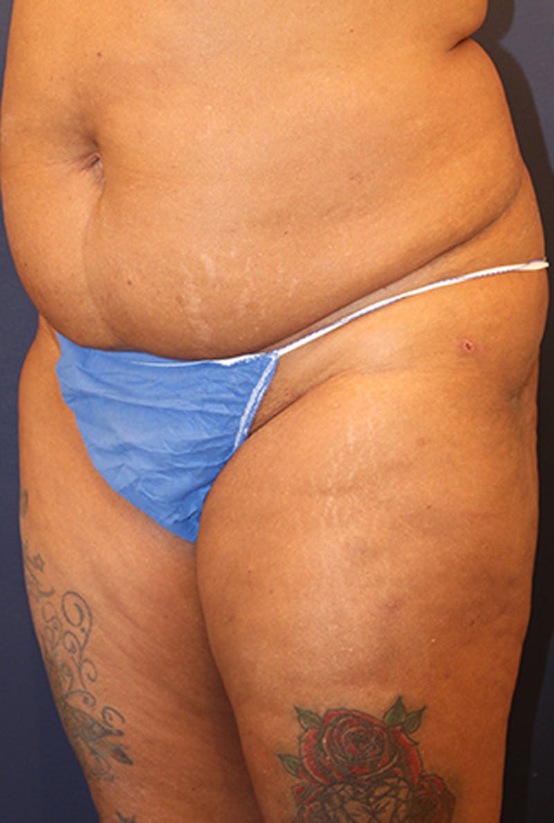 Liposuction Before & After Gallery - Patient 174162081 - Image 3