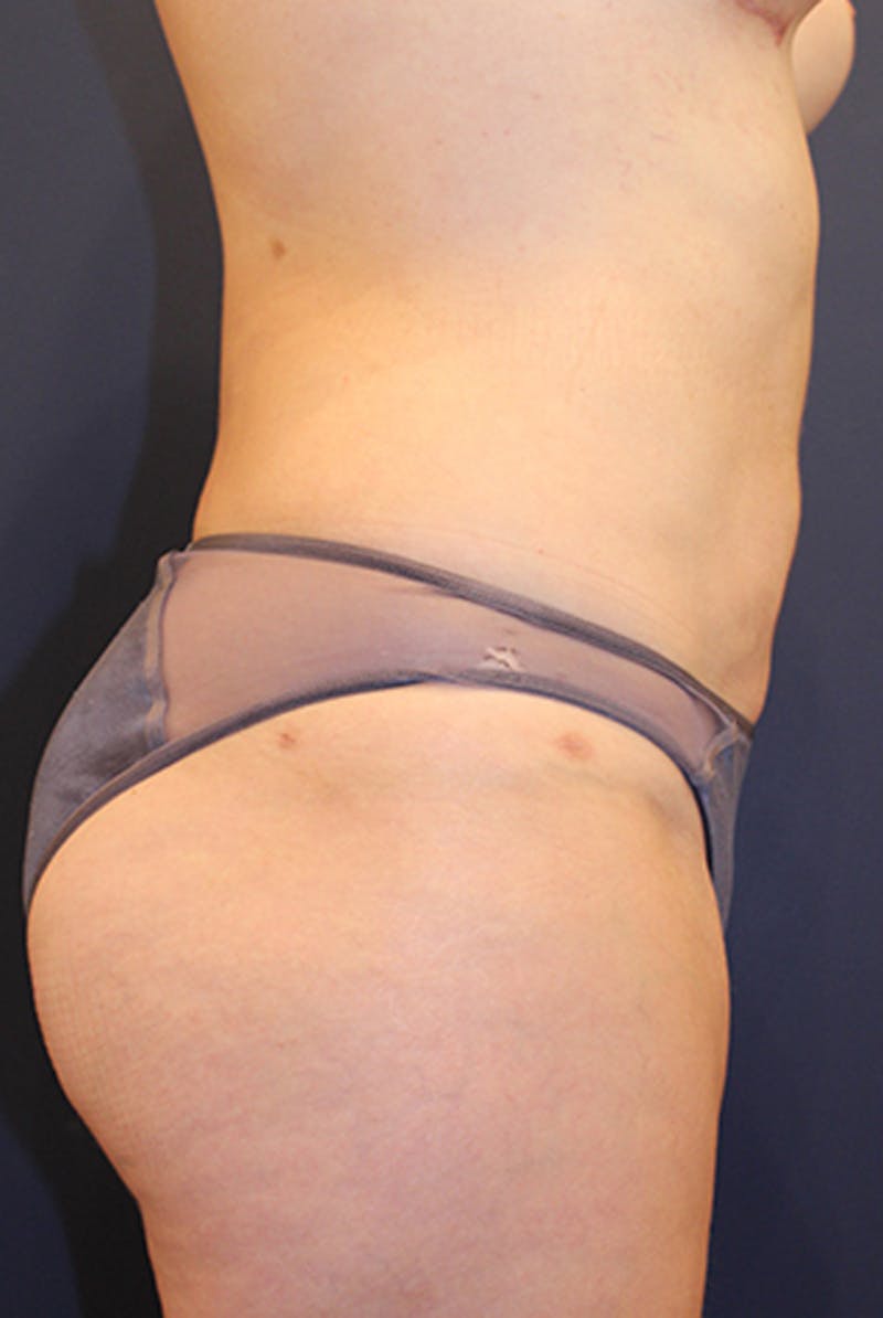 Liposuction Before & After Gallery - Patient 174163162 - Image 6