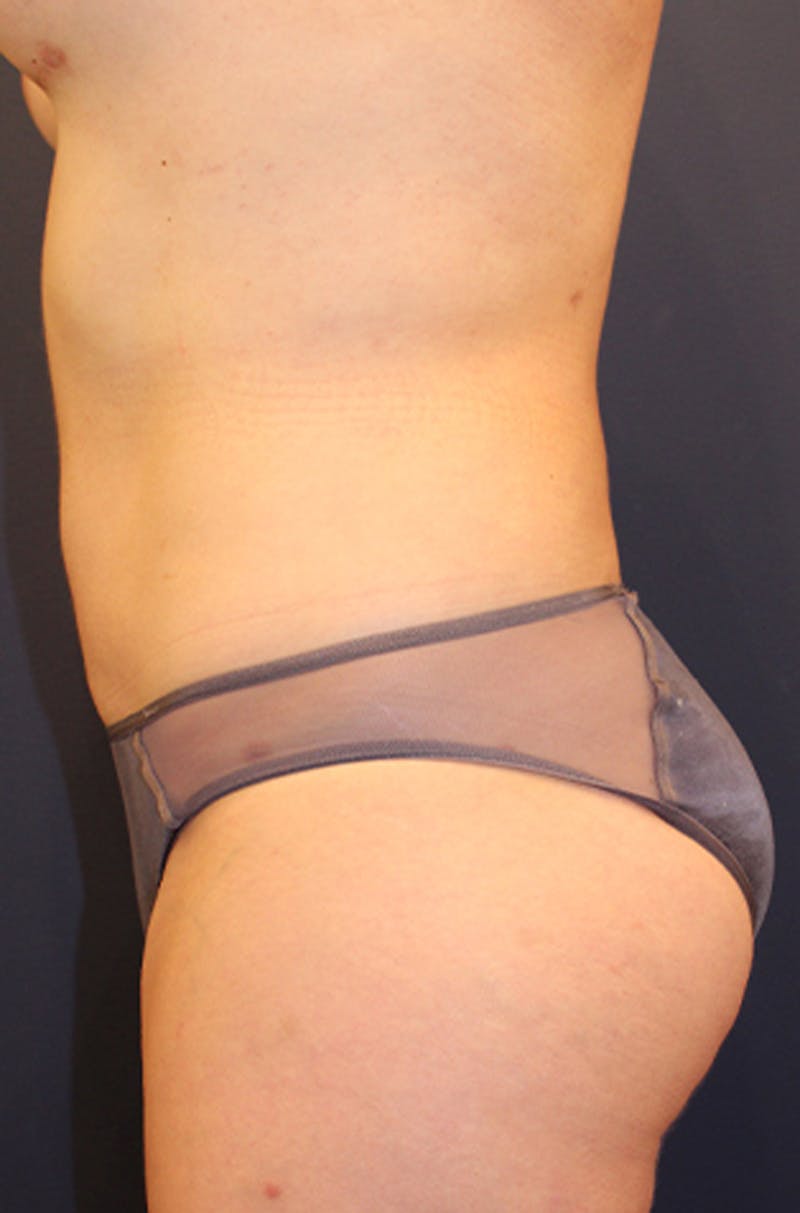 Liposuction Before & After Gallery - Patient 174163162 - Image 4