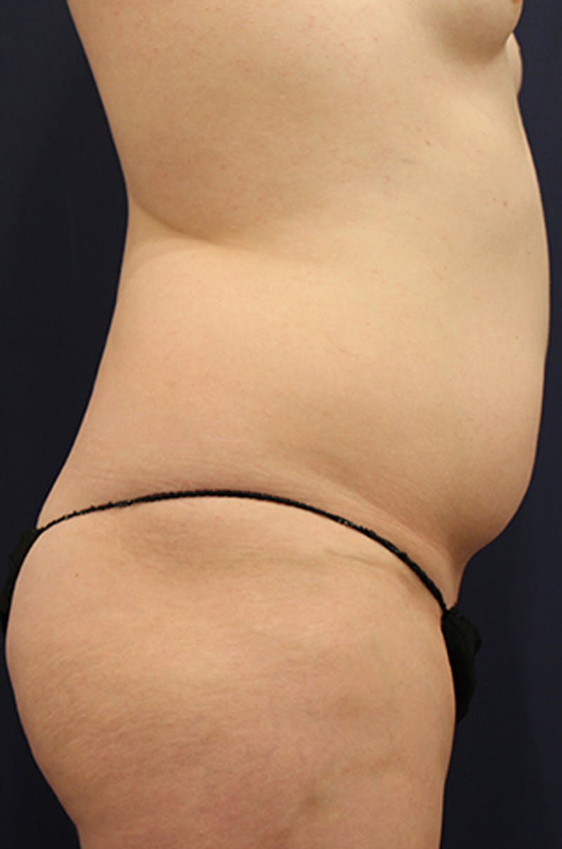 Liposuction Before & After Gallery - Patient 174163162 - Image 5