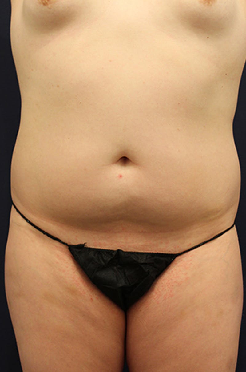 Liposuction Before & After Gallery - Patient 174163162 - Image 1