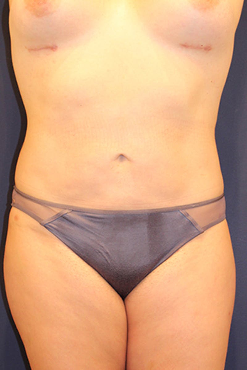 Liposuction Before & After Gallery - Patient 174163162 - Image 2