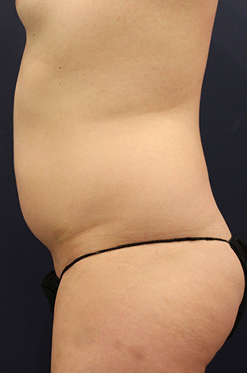 Liposuction Before & After Gallery - Patient 174163162 - Image 3