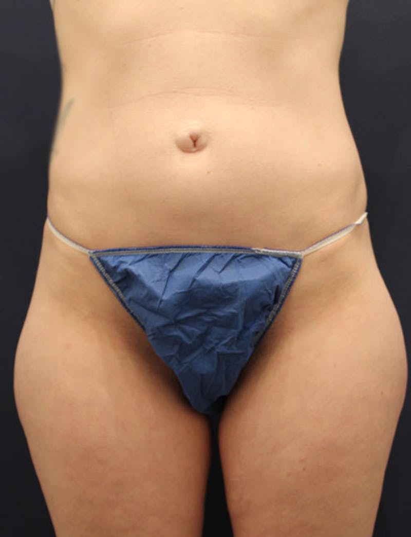 Liposuction Before & After Gallery - Patient 174163168 - Image 1
