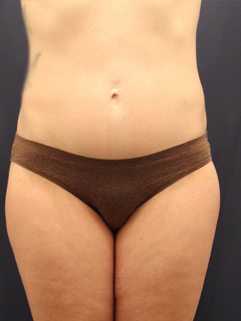 Liposuction Before & After Gallery - Patient 174163168 - Image 2