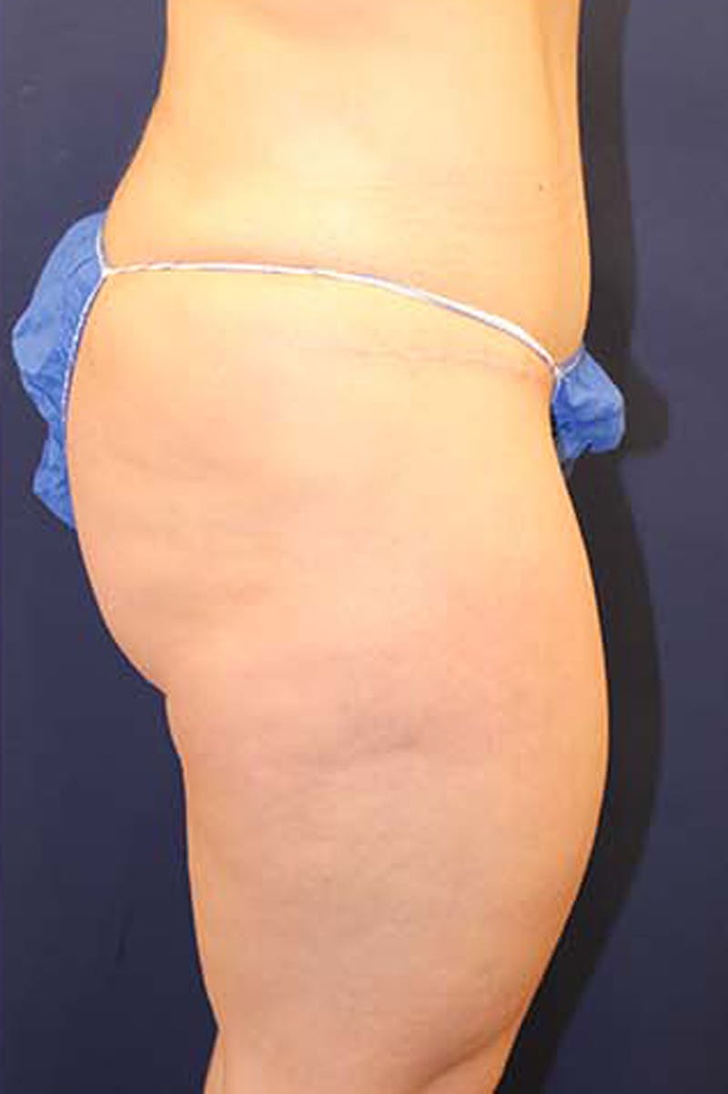 Liposuction Before & After Gallery - Patient 174163174 - Image 6