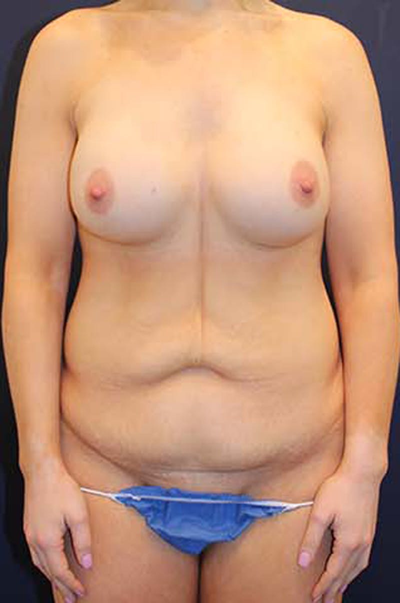 Liposuction Before & After Gallery - Patient 174163174 - Image 1