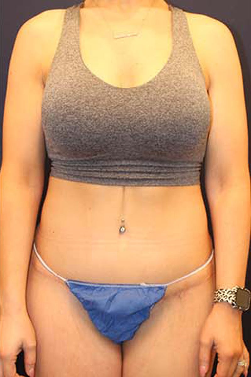Liposuction Before & After Gallery - Patient 174163174 - Image 2
