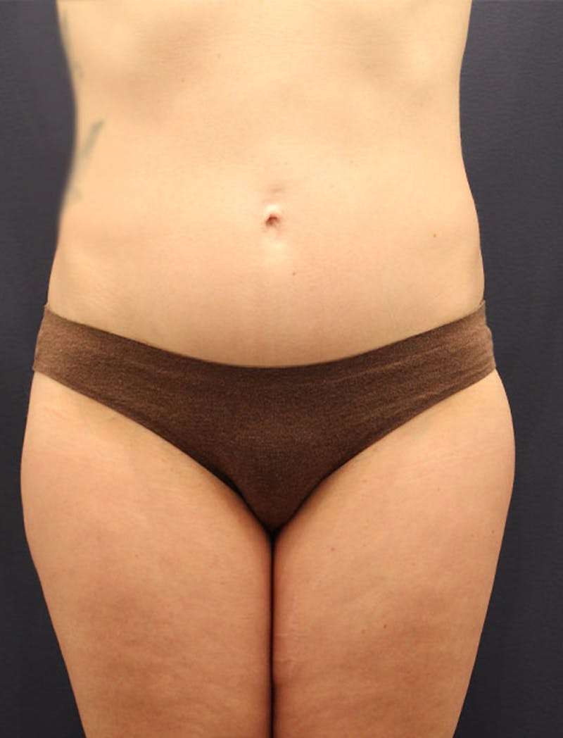 Liposuction Before & After Gallery - Patient 174163180 - Image 2
