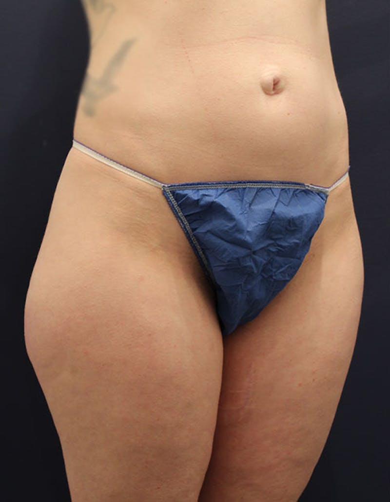 Liposuction Before & After Gallery - Patient 174163180 - Image 3
