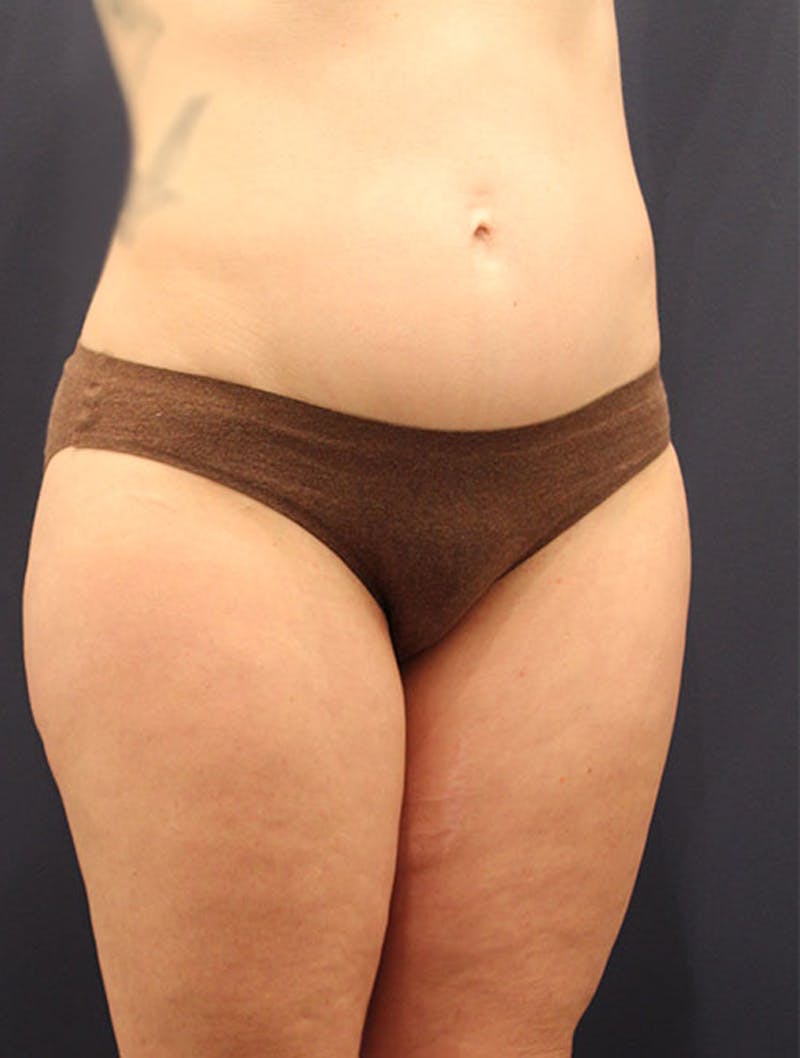 Liposuction Before & After Gallery - Patient 174163180 - Image 4
