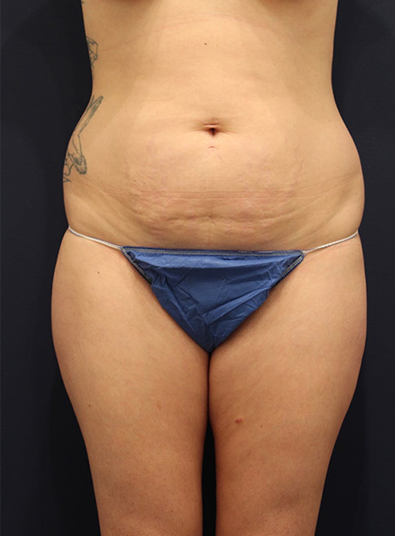 Liposuction Before & After Gallery - Patient 174163190 - Image 1