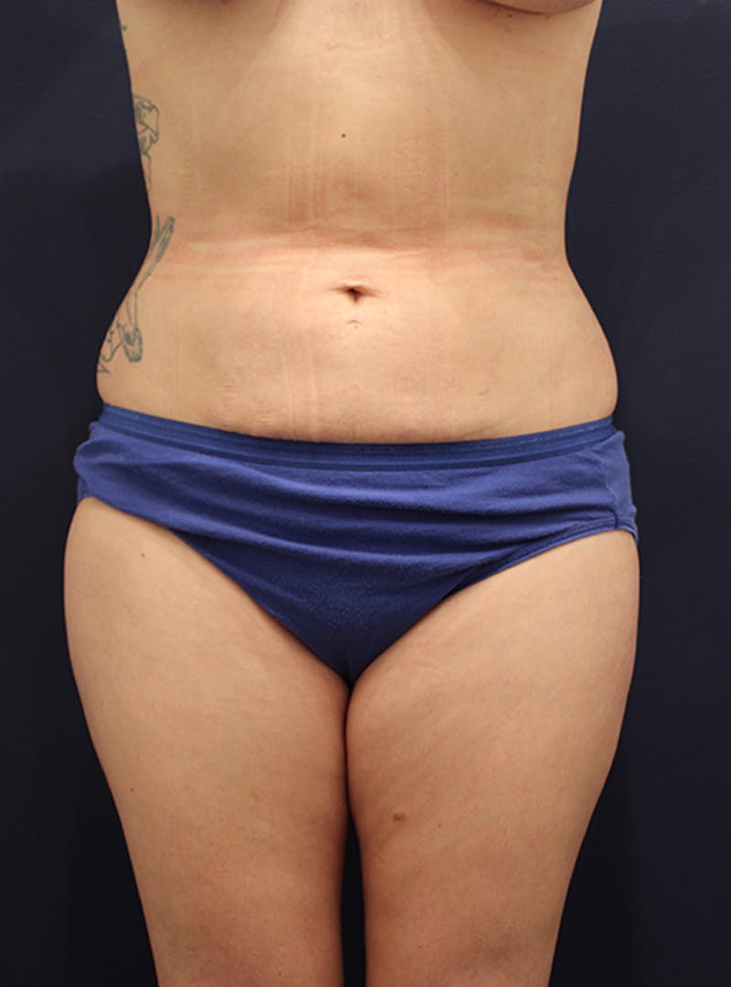 Liposuction Before & After Gallery - Patient 174163190 - Image 2