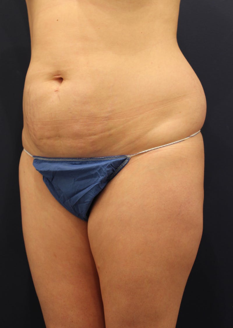 Liposuction Before & After Gallery - Patient 174163190 - Image 3