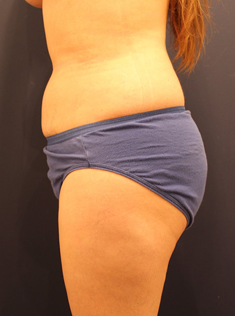 Liposuction Before & After Gallery - Patient 174163190 - Image 6