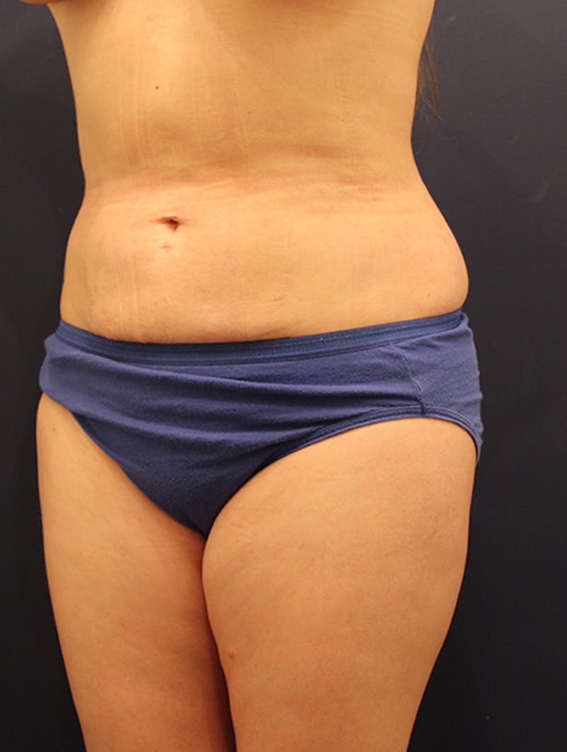 Liposuction Before & After Gallery - Patient 174163190 - Image 4