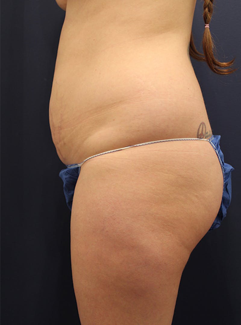 Liposuction Before & After Gallery - Patient 174163190 - Image 5