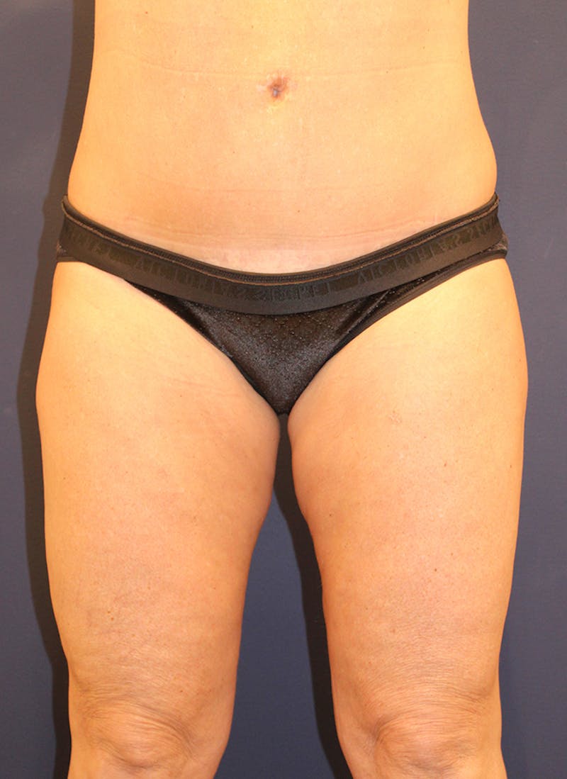 Liposuction Before & After Gallery - Patient 174163198 - Image 1