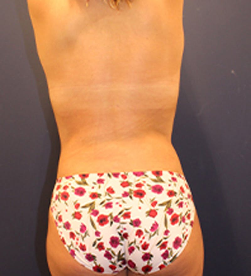 Liposuction Before & After Gallery - Patient 174163206 - Image 8