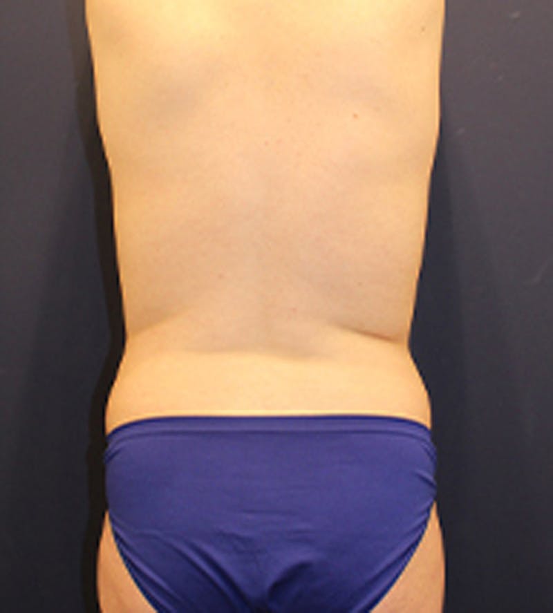 Liposuction Before & After Gallery - Patient 174163206 - Image 7