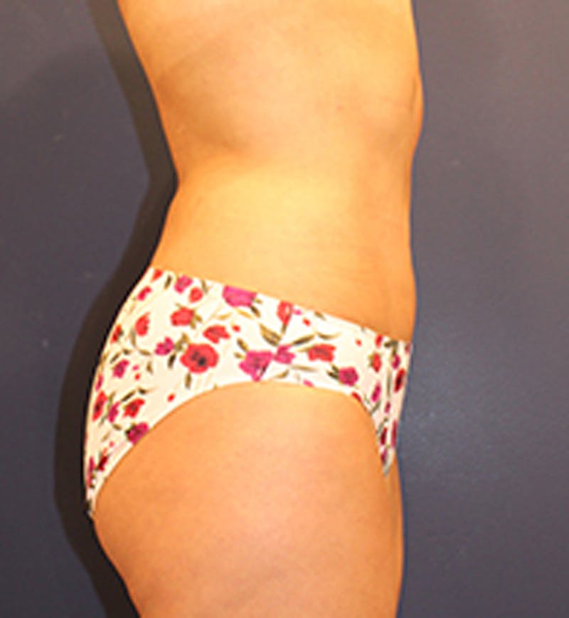 Liposuction Before & After Gallery - Patient 174163206 - Image 6