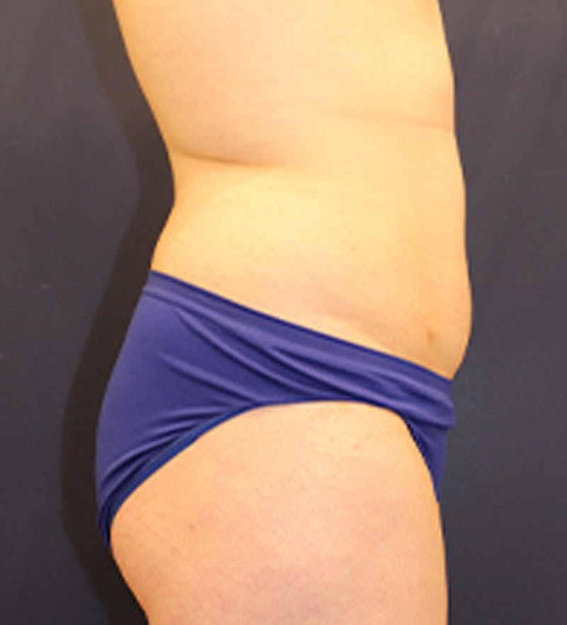 Liposuction Before & After Gallery - Patient 174163206 - Image 5