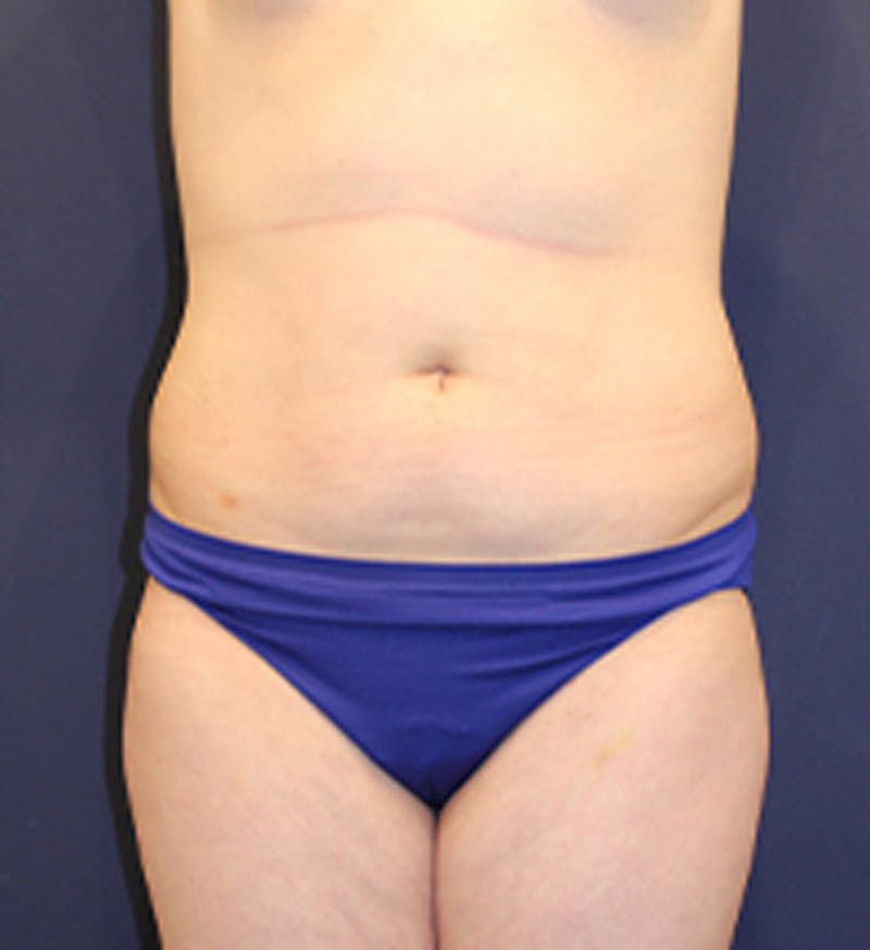 Liposuction Before & After Gallery - Patient 174163206 - Image 1