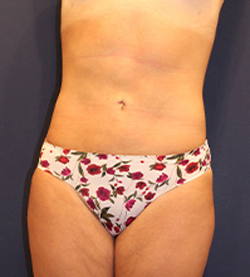 Liposuction Before & After Gallery - Patient 174163206 - Image 2
