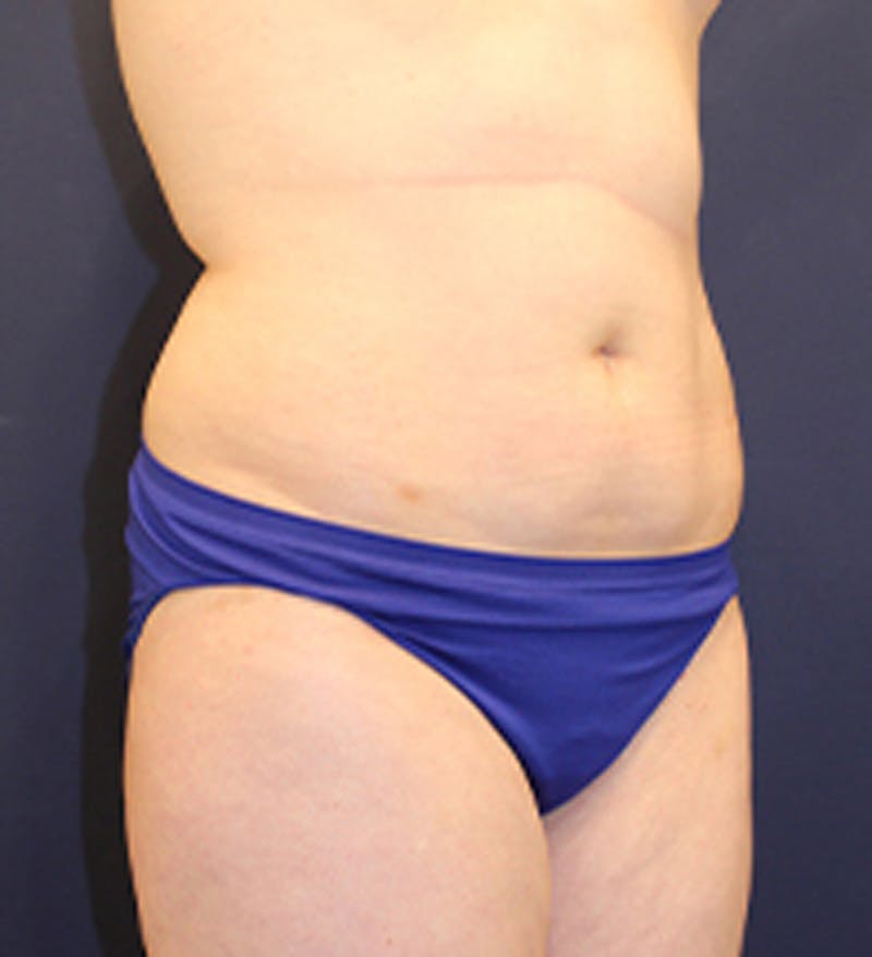 Liposuction Before & After Gallery - Patient 174163206 - Image 3