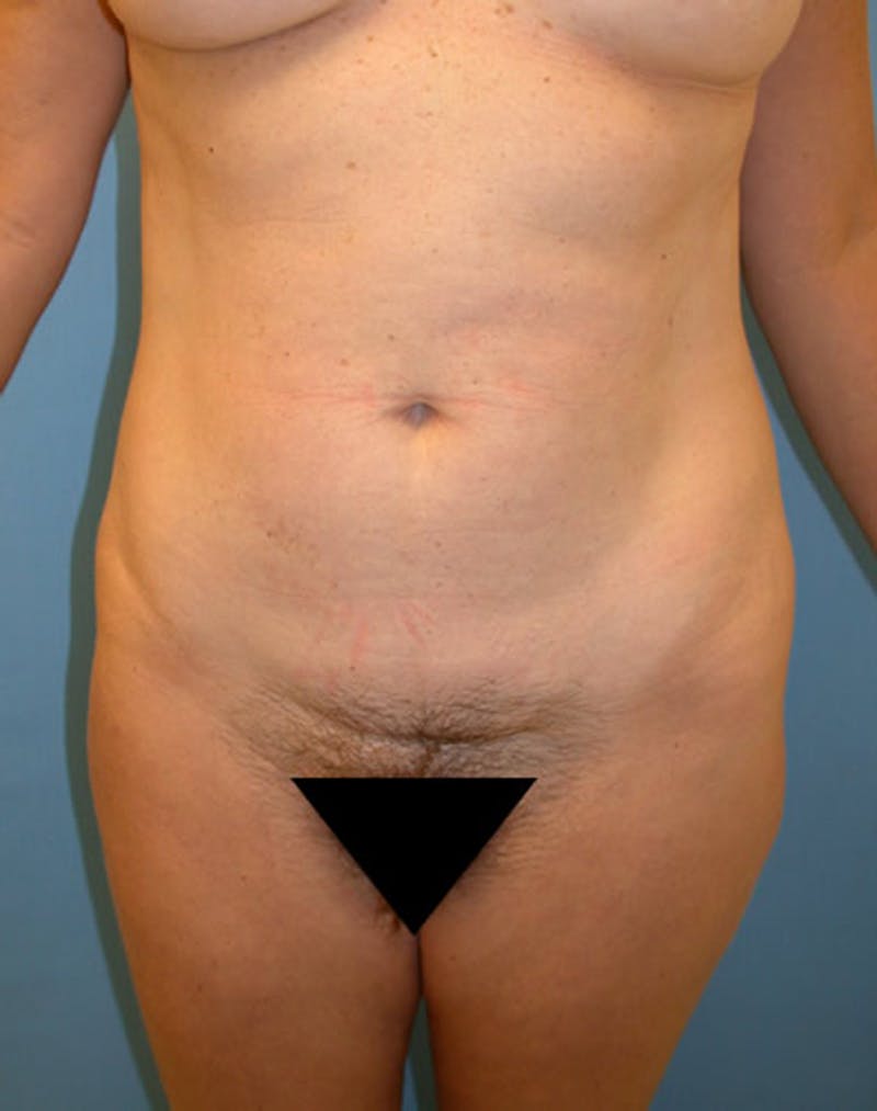 Liposuction Before & After Gallery - Patient 174163212 - Image 1