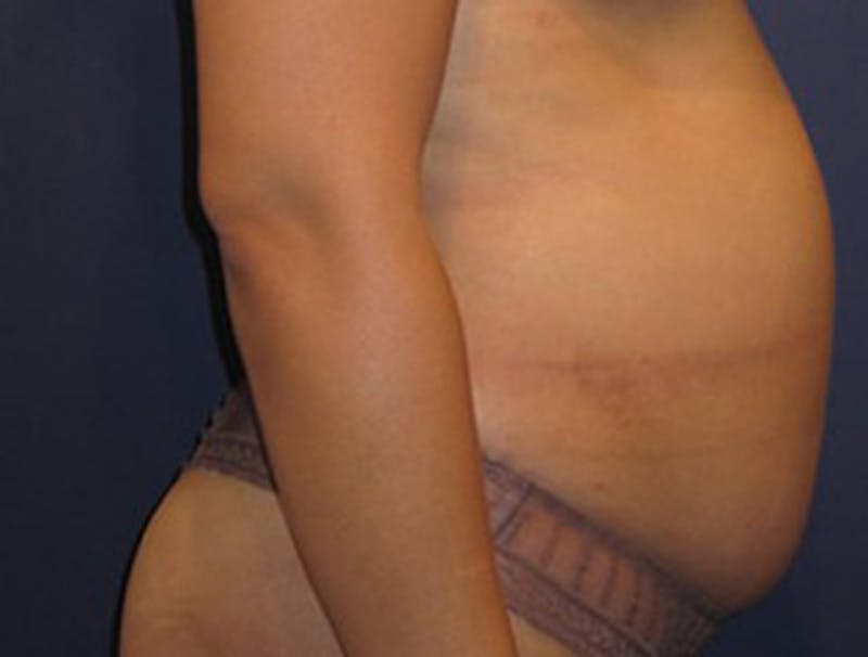Liposuction Before & After Gallery - Patient 174163221 - Image 1