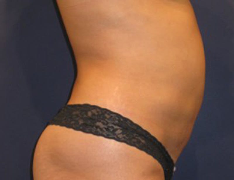 Liposuction Before & After Gallery - Patient 174163221 - Image 2
