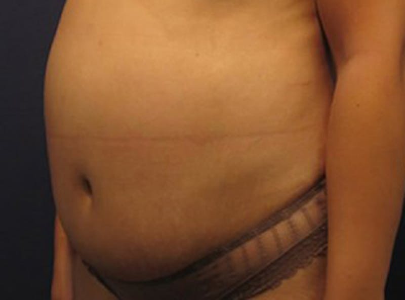 Liposuction Before & After Gallery - Patient 174163221 - Image 3