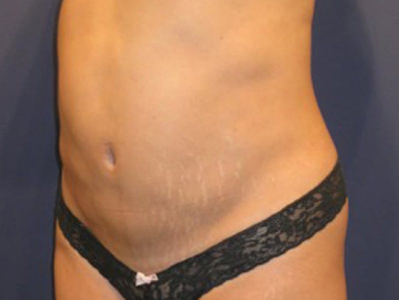 Liposuction Before & After Gallery - Patient 174163221 - Image 4
